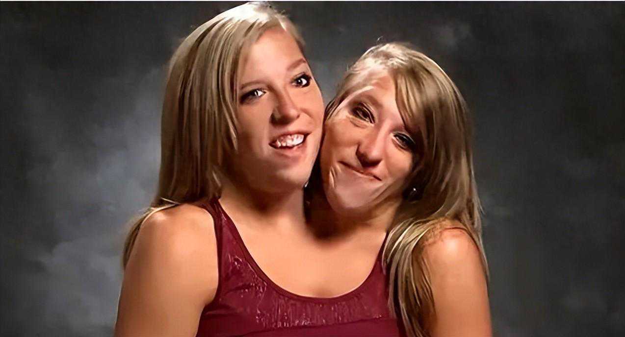 美国“双头姐妹”之一已婚，姐妹只有一个下半身，怎么结婚生子？