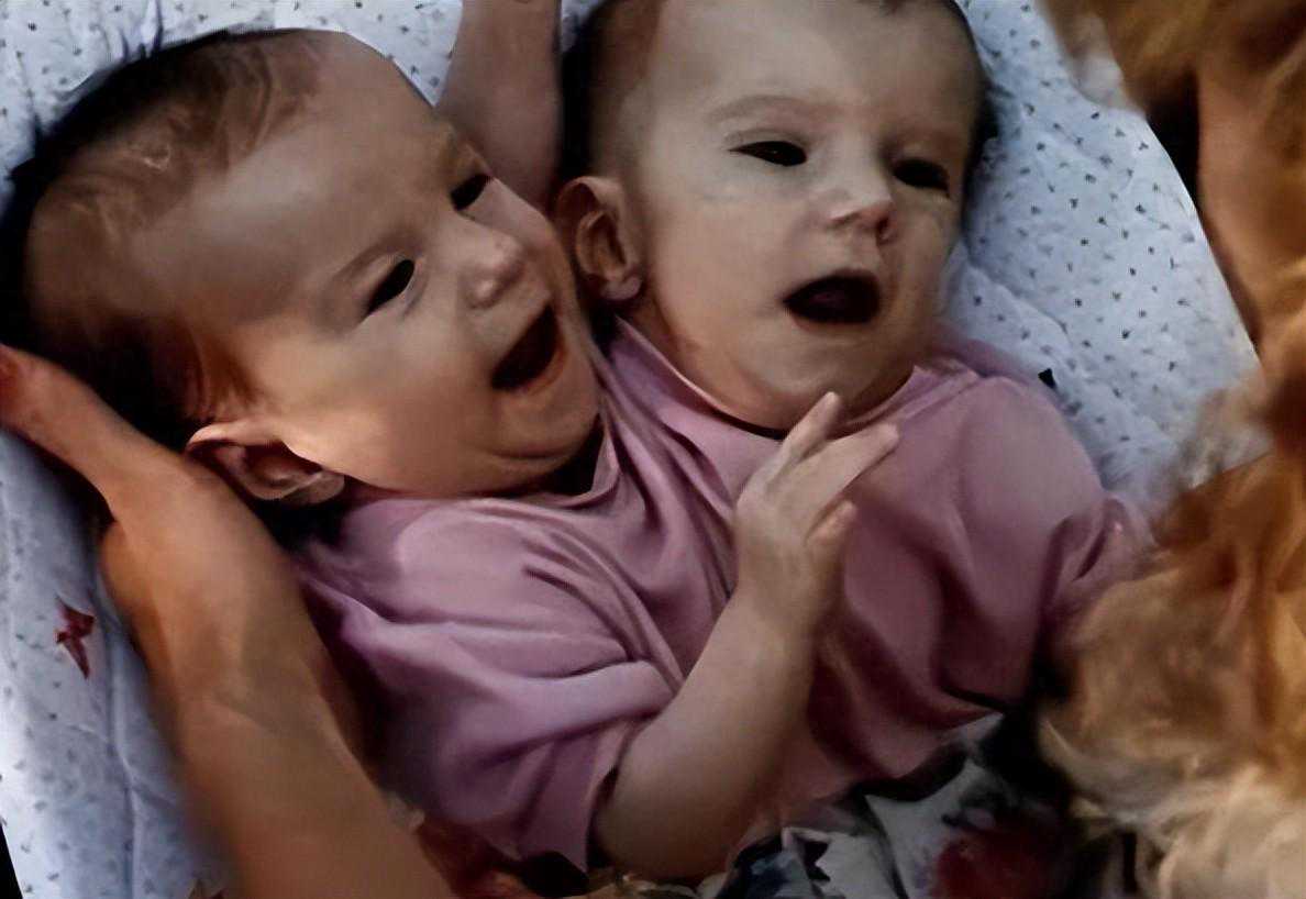 美国“双头姐妹”之一已婚，姐妹只有一个下半身，怎么结婚生子？