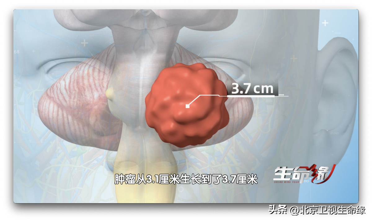 一名麻醉医生患听神经瘤，婚期将至却身陷面瘫风险