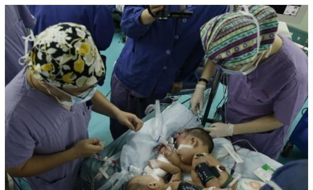 2000年轰动一时的连体女婴，分离术后姐姐逝世，妹妹现在结婚生子